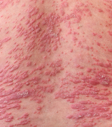 Psoriasis